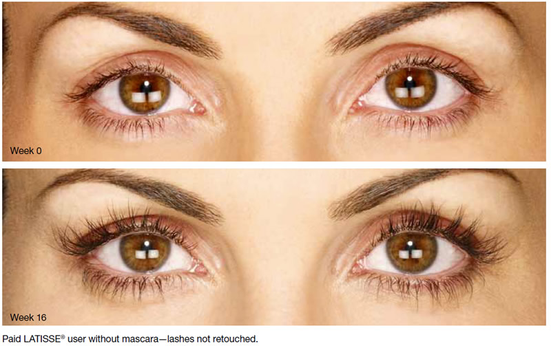 Close up of woman's eyes at week 0 and same woman's eyes with much longer eyelashes at week 16