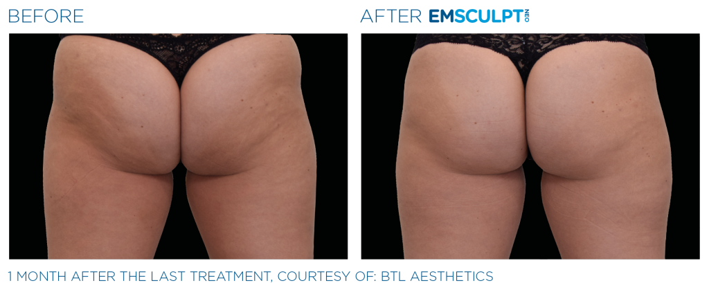 Emsculpt neo buttocks before and after photos