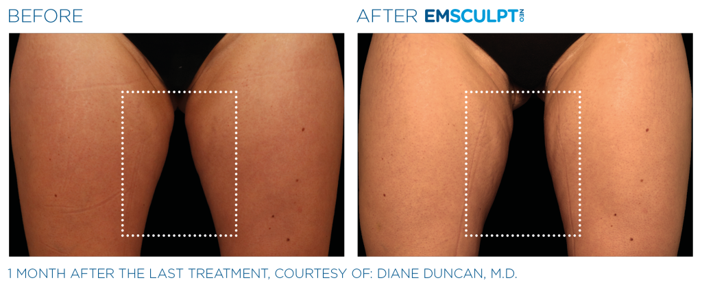 emsculpt neo inner thighs before and after photos