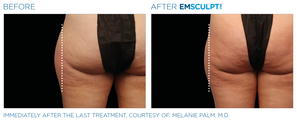 emsculpt neo outer thigh before and after photos