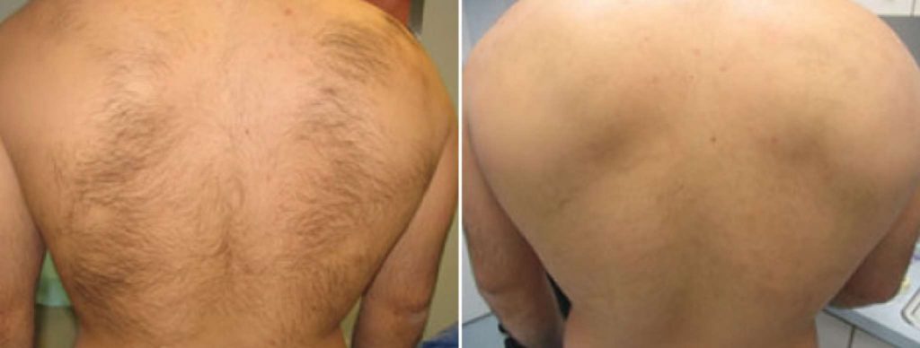 Before and after laser Hair Removal