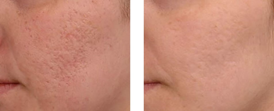 dermapen-before-after1