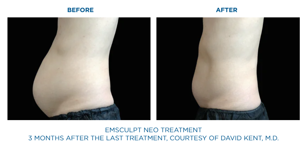 Before and After Emsculpt NEO treatment