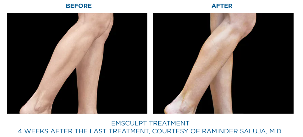 Before and After Emsculpt NEO treatment