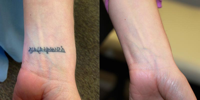 Before and after laser tattoo removal