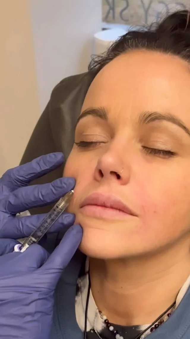 ✨ Bye-bye smile lines, hello smooth skin! ✨

Nasolabial folds? We know them… but we don’t need them. 😉 A little filler here = a lot of youthful glow! 💉

Smooth. Plump. Refresh. — Because your smile should shine, not your lines. 😍

Tag a friend who’s been thinking about getting filler or save this for your next appointment! 💉 

#FillerGoals #NasolabialFoldFiller #MedSpaGlow #YouthfulSkin #SmoothSkin #AestheticInjector #DermalFiller #SkinRejuvenation #SpringGlow #GlowUp #Injectables #MedSpaVibes #AntiAging #FillerBeforeAndAfter