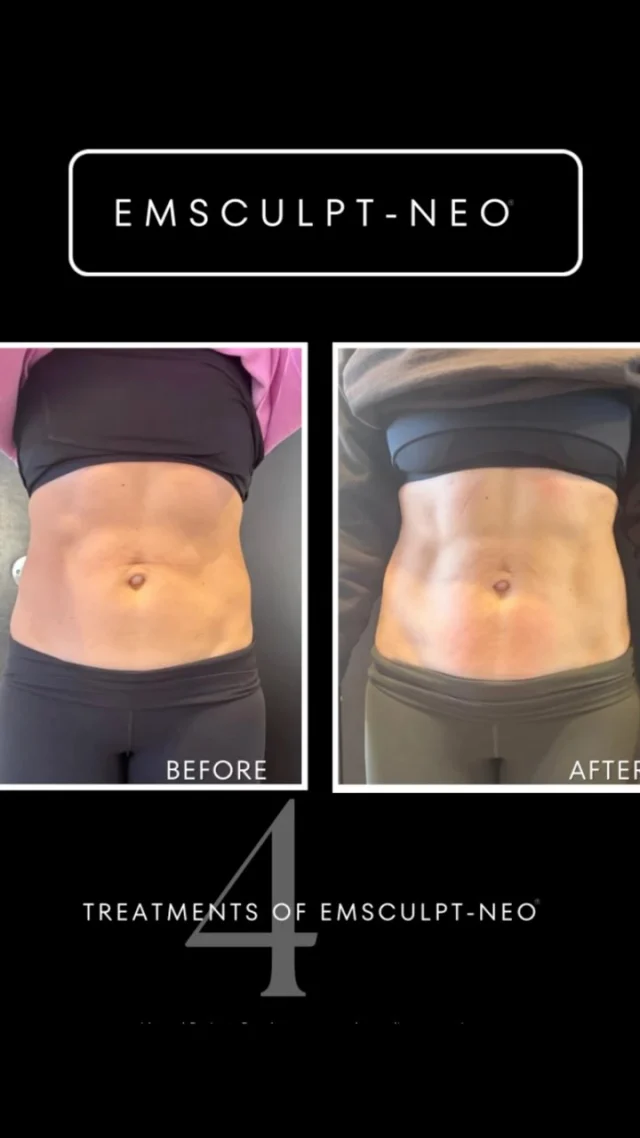 This isn’t a filter, Photoshop or a flattering pose… This is 4 weeks of EmSculpt NEO! 🤯

This technology is WILD—it simultaneously builds muscle AND burns fat using RF heat + 20,000 contractions in just 30 mins. The science? Your body literally CAN’T perform contractions this intense voluntarily.

My client came in wanting subtle definition without spending hours at the gym (mom of 3 with zero extra time). Now she’s got the core strength to keep up with her toddlers AND the confidence to wear that bikini on vacation next month!
✨Most clients see best results after 4 sessions
✨It’s FDA-cleared and takes zero recovery time
✨Results continue improving for 6 weeks AFTER treatments
Is EmSculpt NEO for everybody? No medical treatment is! But for those wanting real contouring with zero downtime, this is why my appointment book stays full.

Drop a ‘💪’ if you want treatment pricing in your DMs!

#TransformationTuesday #EmSculptNEO #RealResults #NoFilter #MedSpaSecrets #BodyContouring