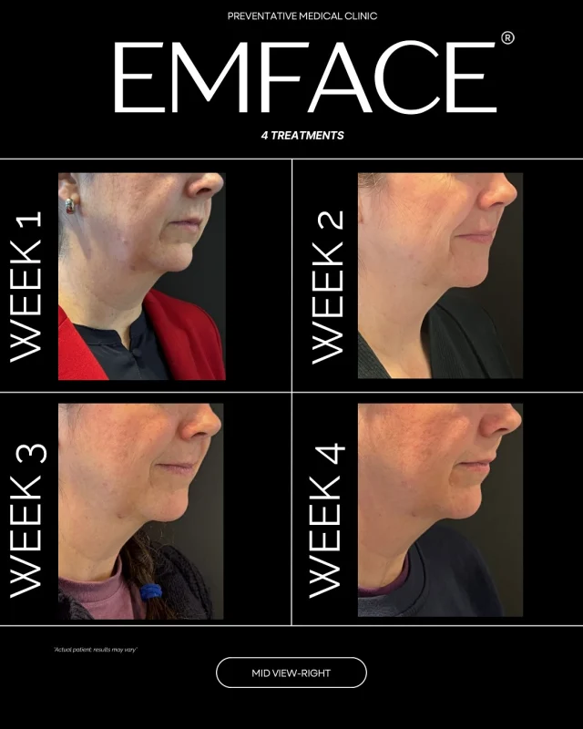 ✨ TRANSFORMATION TUESDAY: EMFACE RESULTS THAT SPEAK FOR THEMSELVES ✨

Swipe to see these remarkable EMFACE results! This patient achieved noticeable jawline definition and cheekbone enhancement after completing just 4 sessions.

What makes EMFACE different? This innovative treatment combines radiofrequency with HIFES technology to simultaneously tone facial muscles and stimulate collagen production—without needles, surgery, or downtime.

Perfect for those seeking natural-looking facial rejuvenation, EMFACE addresses early signs of aging while maintaining your authentic appearance. Each 20-minute session is comfortable, efficient, and fits seamlessly into a busy professional schedule.

We're excited to be offering this breakthrough treatment at our clinic. Limited appointments are available for consultations.

Would you like to learn if EMFACE is right for you? Comment below or message us directly.

#EMFACE #FacialRejuvenation #TransformationTuesday #AgingGracefully #NonInvasiveBeauty #AestheticMedicine #PreventativeSkincare #NaturalResults​​​​​​​​​​​​​​​​