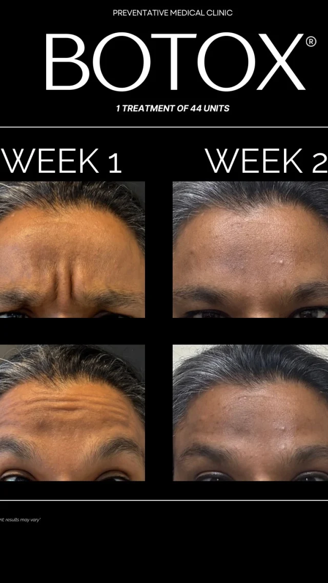 🎯 For two months, she’ll barely move…
Not because she’s tired — but because her forehead is FROZEN 😌💉

That’s the Botox magic ✨
✔️ Softens fine lines
✔️ Prevents deeper wrinkles
✔️ Keeps you looking snatched without looking “done”

👀 Preventative? ✔️
🙌 Minimal downtime? ✔️
⏳ Lasts 3–4 months? ✔️

Your glow-up era is calling 📞💬
Ready to move less and slay more?

#medspa #BotoxBeforeAndAfter #PreventativeBotox #NebraskaMedSpa #BotoxInjection #WrinkleFree #ToxTalk #SkincareRoutine #AestheticsClinic #BotoxQueen #BabyBotox