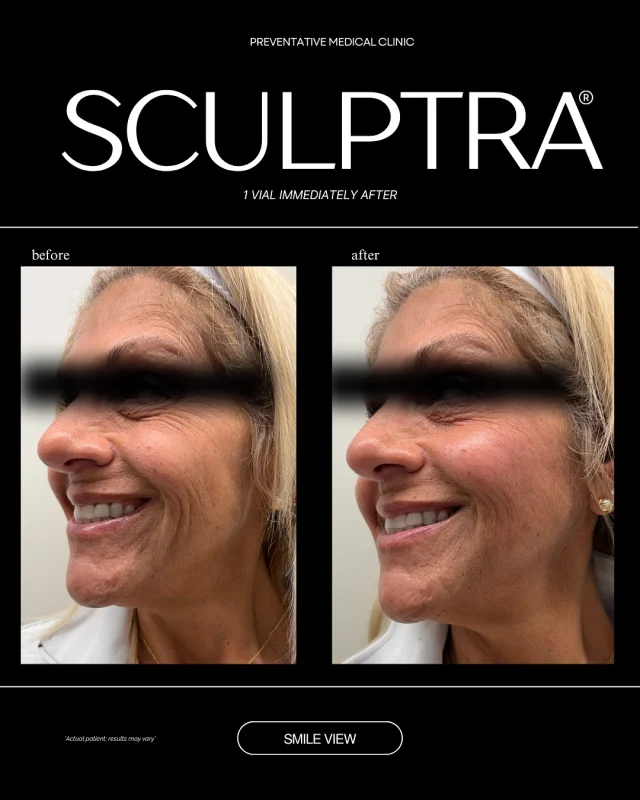 ✨ Sculptra = the glow that grows! ✨
Unlike filler, Sculptra works with your body to rebuild collagen — giving you results that look natural, subtle, and long-lasting. 💫

Think of it as a slow burn confidence booster 🔥 — results develop gradually over weeks, leaving everyone asking “Did she do something? Or is she just glowing?” 😍

📅 Results that last up to 2 years
💉 Stimulates your own collagen
🙌 Perfect for cheeks, temples, and overall facial volume

👉 Save this post if you love natural results.
💬 Comment “GLOW” if you’d try Sculptra!

#SculptraResults #BeforeAndAfter #MedSpa #MedicalAesthetics #CollagenBooster #NaturalResults #AestheticInjector #BeautyEnhancement #SkinConfidence #GlowUpJourney #FacialRejuvenation #AestheticClinic #SculptraGlow #CollagenRestoration #MedSpaTreatment #NonSurgicalLift #AntiAgingTreatment #SkinGoals #BeautyTrends2025 #TrustTheProcess