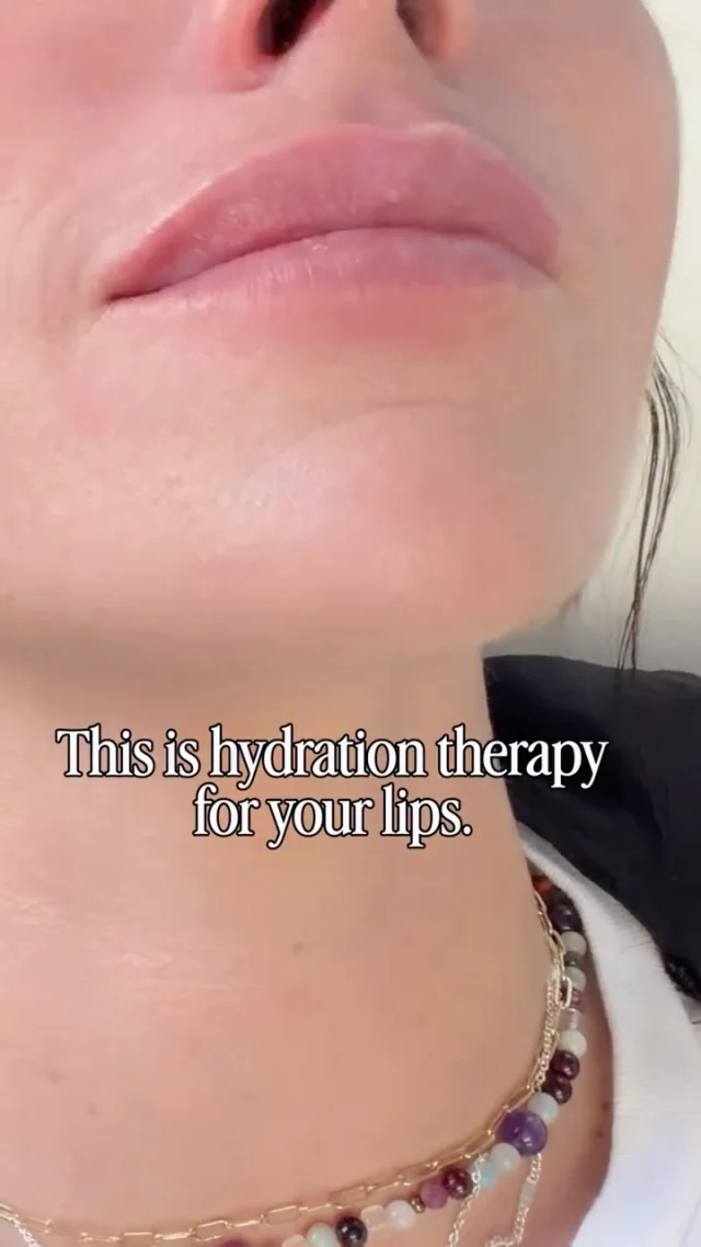 This is NOT lip filler.
This is hydration therapy for your lips. 💧✨

Skinvive by JUVÉDERM® doesn’t add volume or change your shape. Instead, it delivers micro-droplets of hyaluronic acid directly into the skin to improve hydration, texture, and smoothness from the inside out.

Perfect for lips that feel:
✔️ dry or crepey
✔️ dull or dehydrated
✔️ lined but not deflated
✔️ like they’ve lost their glow

Skinvive helps restore bounce, softness, and healthy shine — without looking “done.”
Think: naturally hydrated, plump-looking lips that still look like yours.

If you’ve ever said, “I don’t want filler, I just want my lips to look better,”
this is your sign. 👀✨

Hydrated lips are always in.
Book your Skinvive treatment at @pmcomaha 

#Skinvive #SkinviveByJuvederm #LipHydration #NotFiller #NaturalAesthetics #HydratedLips #MedicalAesthetics #MedSpaLife #OmahaMedSpa #PMCOmaha #Injectables #ProAging #HealthySkin #LipRejuvenation #AestheticReels #SkinQuality