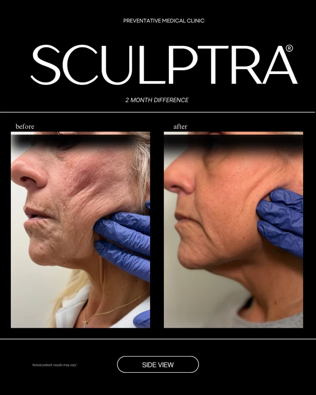 This is your sign that good things take time. ⏳✨

What you’re seeing here is the 2-month difference with Sculptra — and no, this isn’t “filler settling.”
Sculptra works differently.

Instead of adding instant volume, Sculptra stimulates your body to rebuild its own collagen — meaning results show up gradually, naturally, and beautifully over time.

Here’s what happens over those first 2 months 👇
✔️ collagen production begins
✔️ skin thickness improves
✔️ subtle volume returns
✔️ facial structure looks softer and more supported
✔️ everything looks refreshed — not “done”

The best part?
People don’t ask what you did.
They ask why you look so good. 👀✨

Sculptra is perfect for patients who want:
• long-lasting results
• natural facial rejuvenation
• improved skin quality
• gradual changes that age with you

✨ Results continue improving for up to 6 months and can last 2+ years with proper treatment planning.

If instant isn’t your vibe and natural is…
Sculptra might be your treatment.
Book your consultation at @pmcomaha 💉✨

#Sculptra #SculptraResults #CollagenStimulation #Biostimulator #NaturalAesthetics FacialRejuvenation AestheticMedicine MedSpaLife OmahaMedSpa PMCOmaha BeforeAndAfter AestheticReels SkinQuality ProAging LongLastingR
