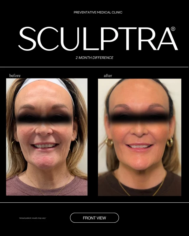 💉Sculptra: Subtle, Strategic, Powerful

This before & after isn’t about volume.
It’s about structure, skin quality, and support. ✨

Sculptra works beneath the surface by stimulating collagen where we naturally lose it over time — helping restore the framework that keeps the face looking smooth and balanced.

What you may notice in this transformation:
✔️ improved facial support
✔️ softened hollows and shadows
✔️ smoother transitions between facial features
✔️ healthier, thicker-looking skin
✔️ results that don’t look injected — just refreshed

Unlike traditional filler, Sculptra doesn’t add instant fullness.
It encourages your body to rebuild collagen gradually, so the changes blend in naturally with your face.

This is why Sculptra is ideal for patients who want:
• long-term rejuvenation
• subtle, progressive improvement
• natural aging — on your terms
• results that last beyond one season

✨ Collagen continues building for months
✨ Results can last up to 2+ years

If you’re looking for change without the obvious “done” look,
Sculptra may be your answer.

📍 Omaha, NE
🔗 Consultations available at @pmcomaha