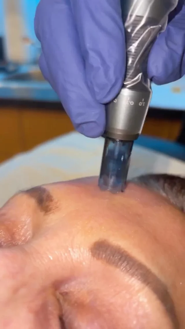 PRP VAMPIRE FACIAL 🩸

Wrinkles? ✔️
Texture? ✔️
Fine lines? ✔️
Collagen building? ✔️
Firmness? ✔️
That perfect glow? ✔️✨

This is your sign to stop chasing filters and start stimulating your own skin.

The Vampire Facial (PRP) works by using your body’s natural growth factors to:
• boost collagen production
• improve skin texture and tone
• soften fine lines
• enhance firmness
• create a healthy, long-lasting glow

No filler. No volume.
Just your skin — but better.

If you’re ready for results that look natural, build over time, and age beautifully…
✨ this treatment belongs on your skincare plan.

📍 Omaha, NE
🔗 Book your PRP facial at @pmcomaha 

#OmahaMedSpa #OmahaAesthetics #OmahaSkin #NebraskaMedSpa #PMCOmaha VampireFacial PRPFacial MedicalAesthetics MedSpaReels OmahaSmallBusiness GlowUpOmaha ElkhornNE PapillionNE LaVistaNE CouncilBluffs

VampireFacial PRPFacial SkinRejuvenation CollagenBuilding MedicalAesthetics MedSpaLife OmahaMedSpa PMCOmaha AestheticReels SkinGoals NaturalGlow AntiAgingTreatments SelfCareRoutine AestheticClinic GlowUpSeason