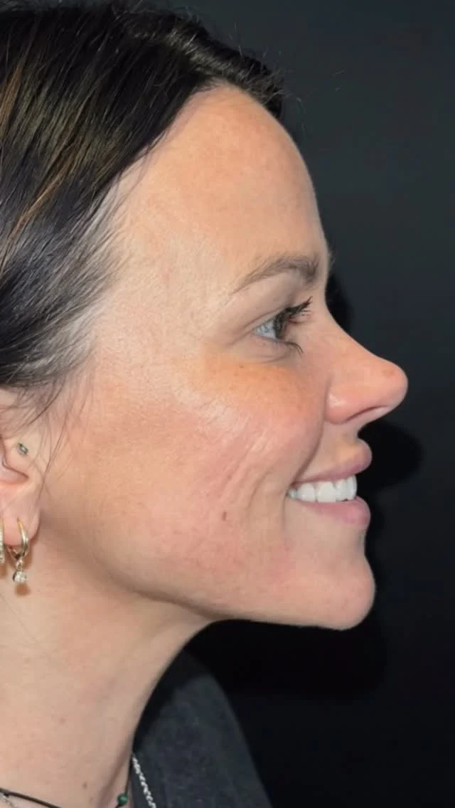 She didn’t want to look different. She just wanted to look like herself again.
Juvederm Vollure for her smile lines. A little facial balancing. And suddenly she’s back — just more rested, more lifted, more her.

That’s what we do here at PMC. Juvederm Day is June 18 & there's still a few spots left! 

🗓️ DM us to book. New patients welcome 💉

#juvederm #omahamedspa #omahaaesthetics #facialbalancing