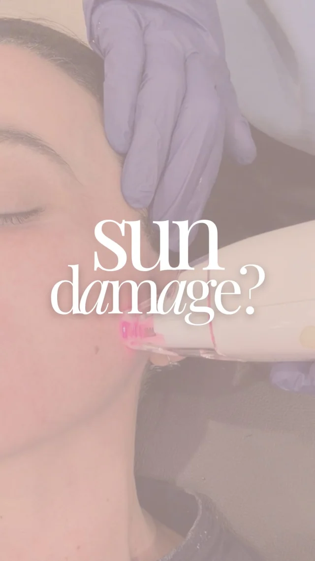 You can’t undo the sun damage from Spring Break ’04… ☀️😅 But you can treat it. ✨

Years of UV exposure can leave behind sun spots, age spots, freckles, uneven skin tone, fine lines, wrinkles, redness, and dull skin—but advanced laser skin rejuvenation can help restore a brighter, healthier-looking complexion.

Our medical-grade laser treatments are designed to:
✨ Treat sun damage
✨ Fade brown spots & pigmentation
✨ Improve skin texture
✨ Stimulate collagen production
✨ Reduce fine lines & wrinkles
✨ Brighten dull skin
✨ Reveal a more even skin tone

Whether you’re noticing years of sun exposure or simply want healthier, glowing skin, we’ll help create a personalized treatment plan based on your skin goals.

📍Serving Omaha, Nebraska and the surrounding Midwest communities.

#LaserSkinRejuvenation #SunDamage #SunSpotRemoval #AgeSpots #Hyperpigmentation BrownSpots CollagenStimulation SkinRejuvenation LaserTreatment FineLines